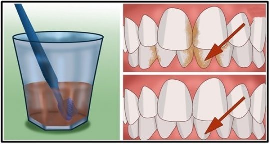 Permalink to Cara Mudah Bersihkan Karang Gigi dan Memutihkan Gigi Kuning dengan Cepat